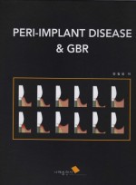PERI-IMPLANT DISEASE & GBR