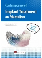 Contemporary of Implant Treatment on Edentulism