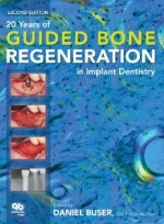 20 Years of Guided Bone Regeneration in Implant Denistry [Hardcover]