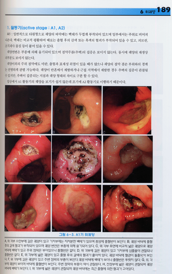 상부 위장관 내시경 ATLAS