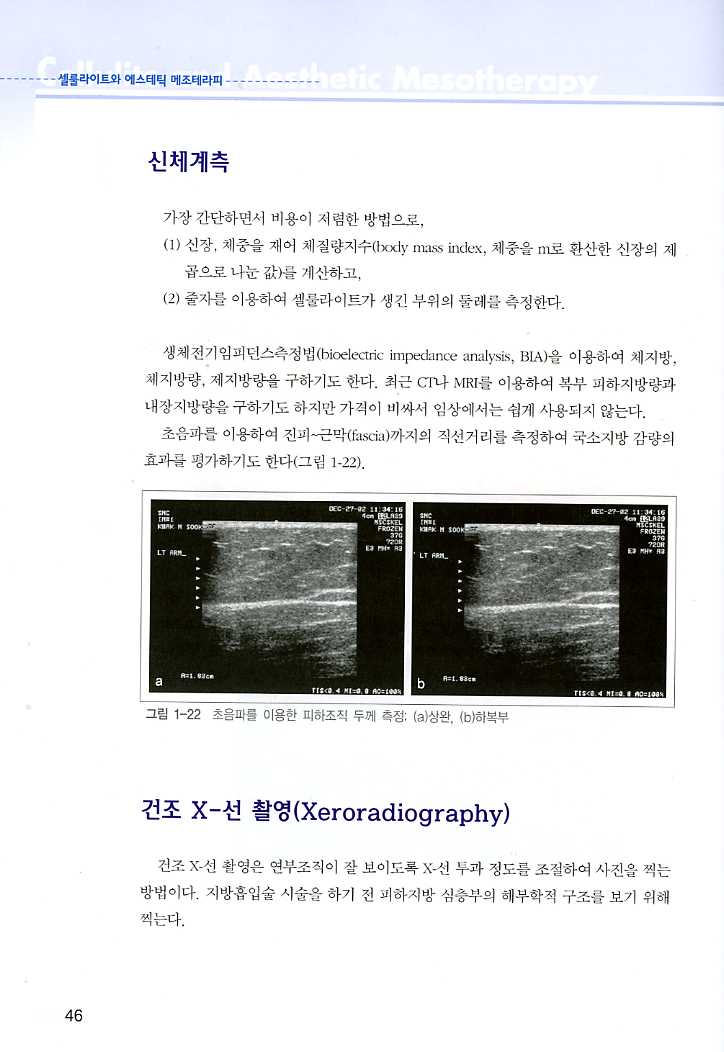 셀룰라이트와 에스테틱 메조테라피