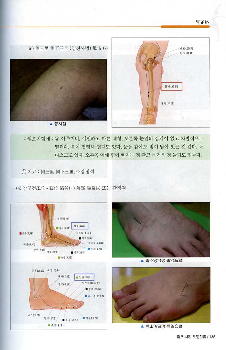 월오 사암오행침법 (일중사)