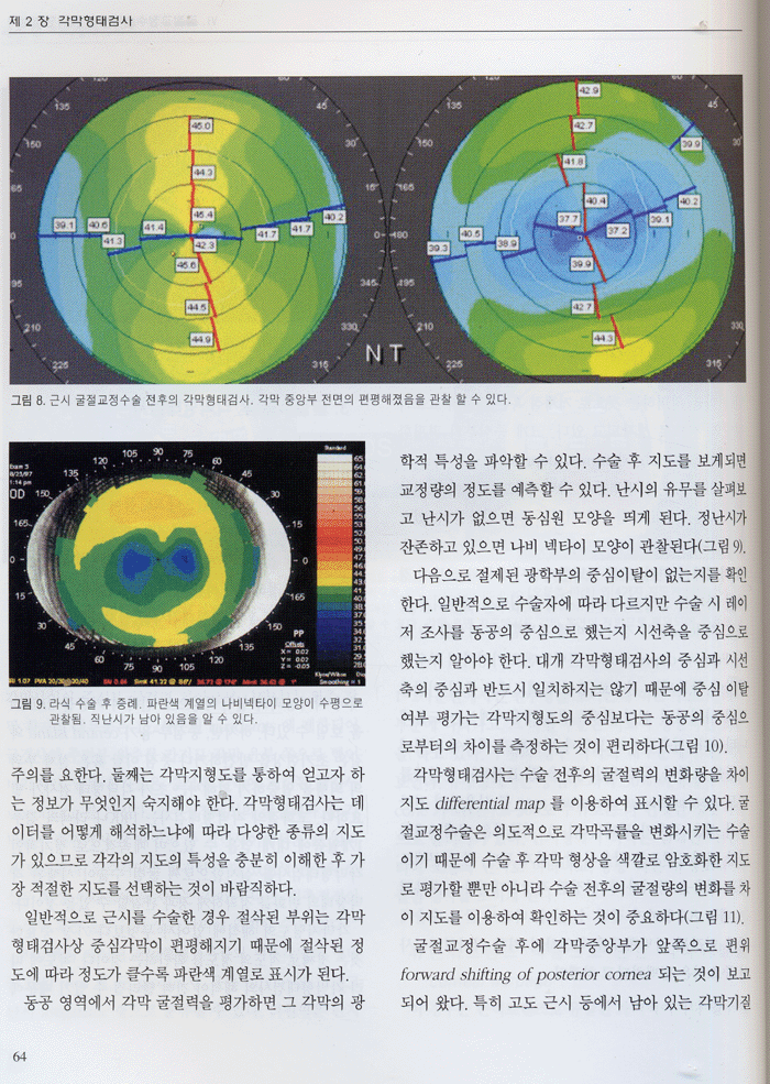 굴절교정수술