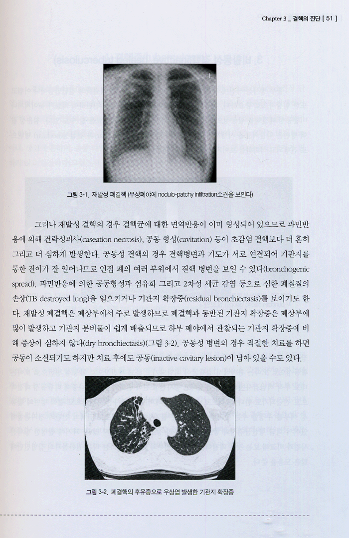 알기쉬운 결핵 2005년 최신지견