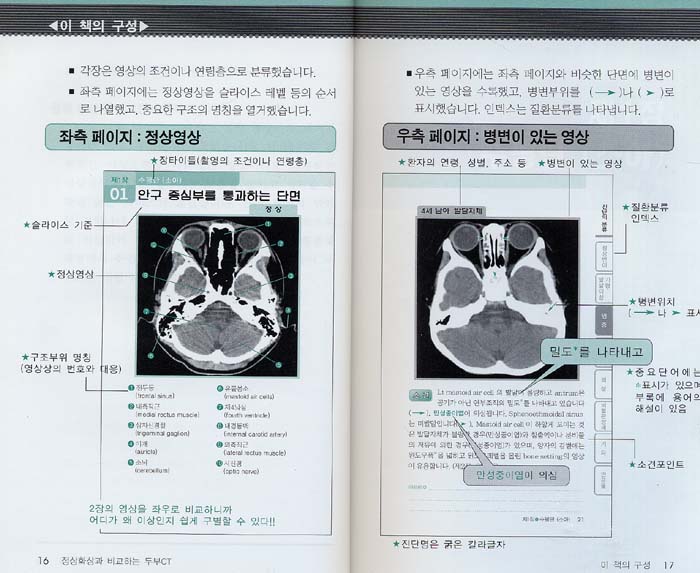 정상영상과 비교하는 두부 CT