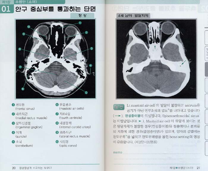 정상영상과 비교하는 두부 CT