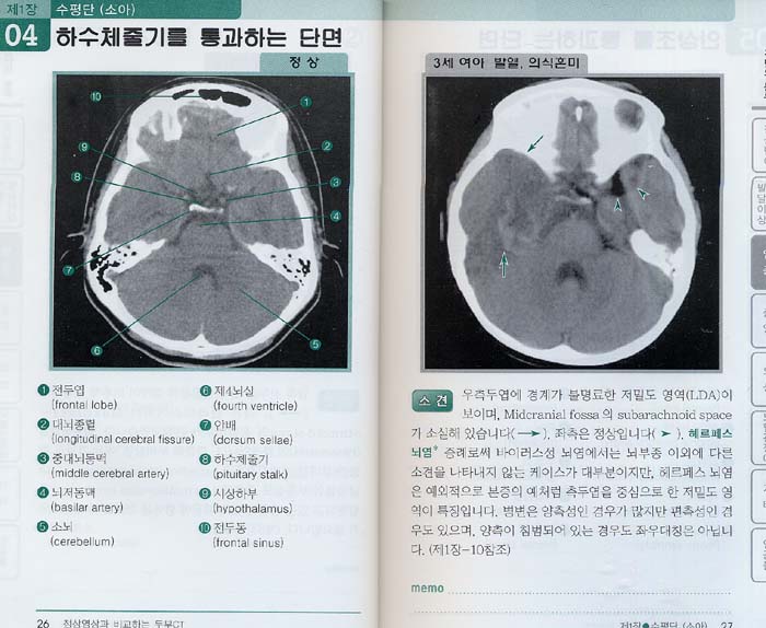 정상영상과 비교하는 두부 CT