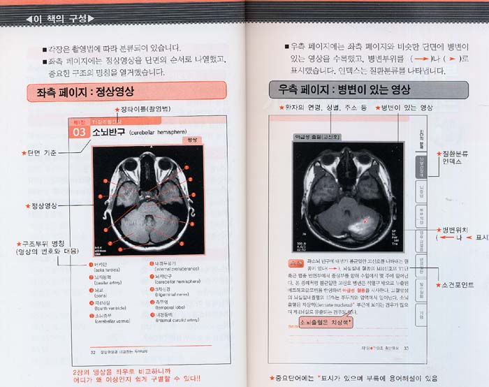 정상영상과 비교하는 두부MRI