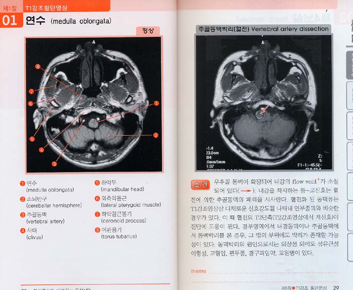 정상영상과 비교하는 두부MRI