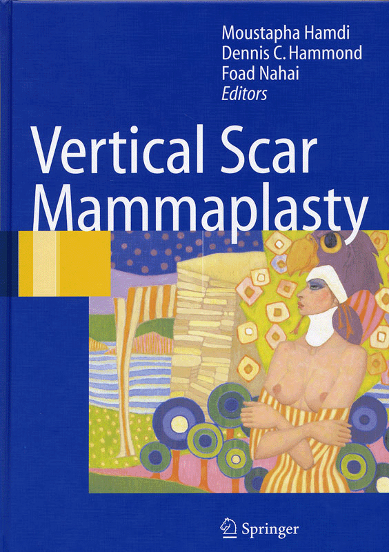 Vertical Scar Mammaplasty