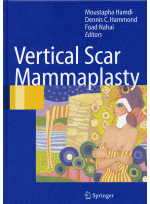 Vertical Scar Mammaplasty