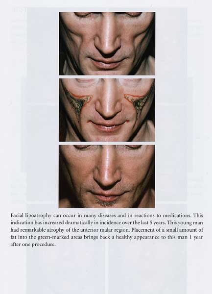 Structural Fat Grafting