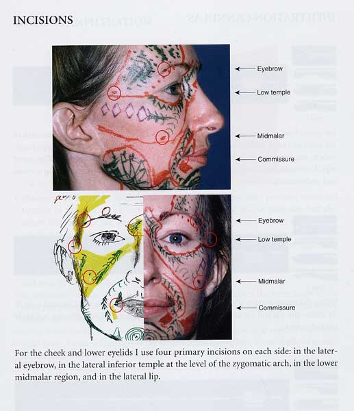 Structural Fat Grafting