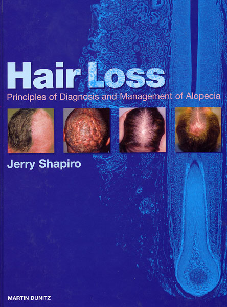 Hair Loss : Principles of Diagnosis and Management Alopecia