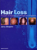 Hair Loss : Principles of Diagnosis and Management Alopecia