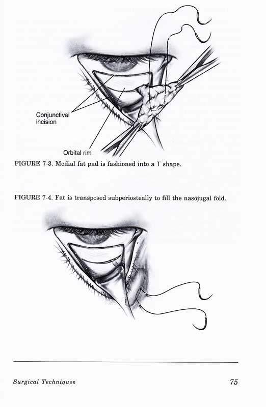 Gladstone and Nesi\'s Oculoplastic Surgery Atlas:Cosmetic Fac