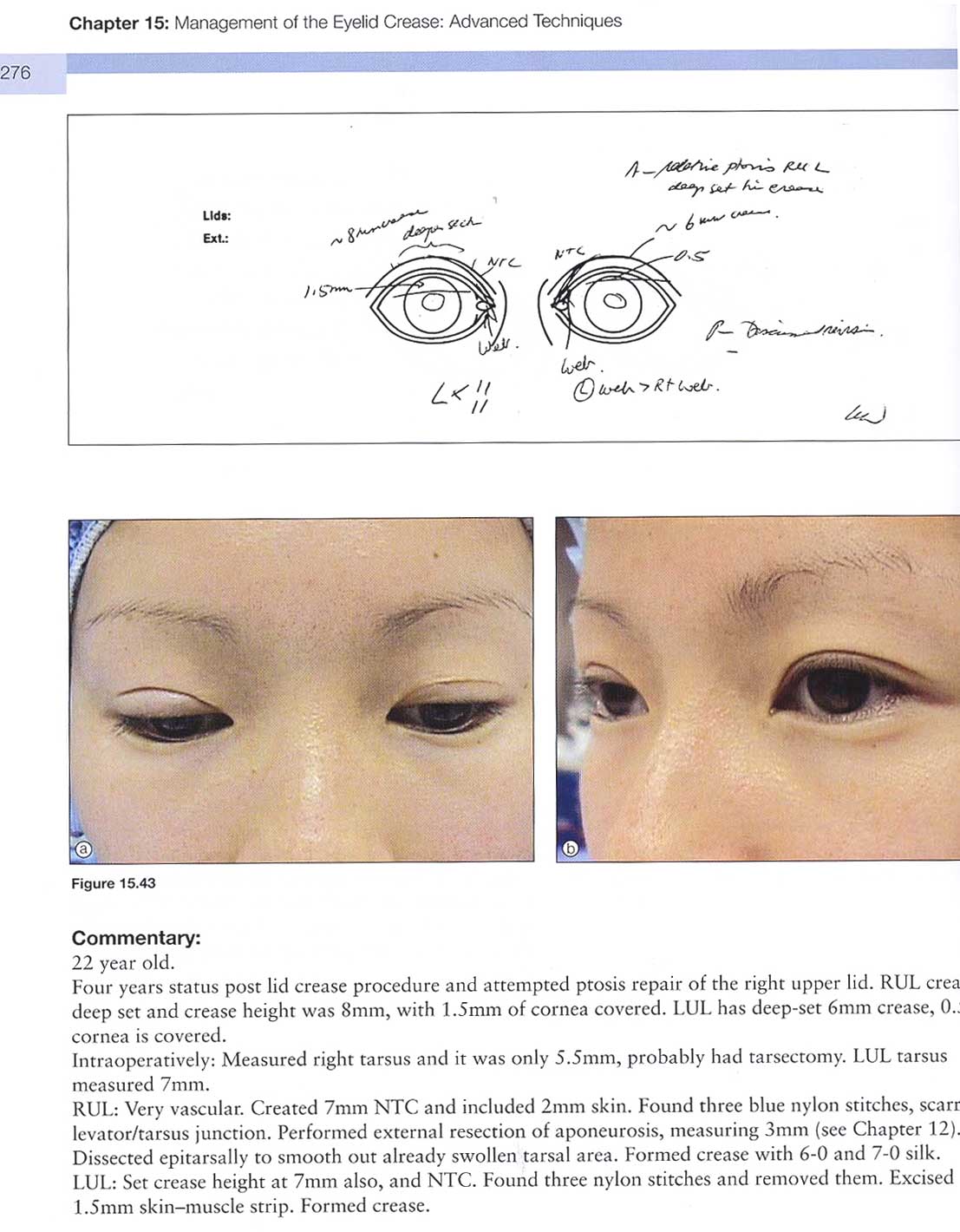 Color Atlas Of Cosmetic Oculofacial Surgery