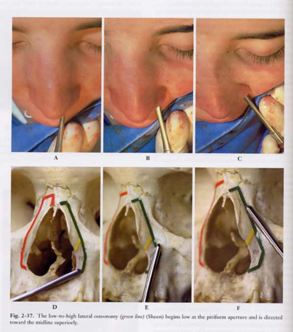 Atlas of Rhinoplasty : Open and Endonasal Approaches