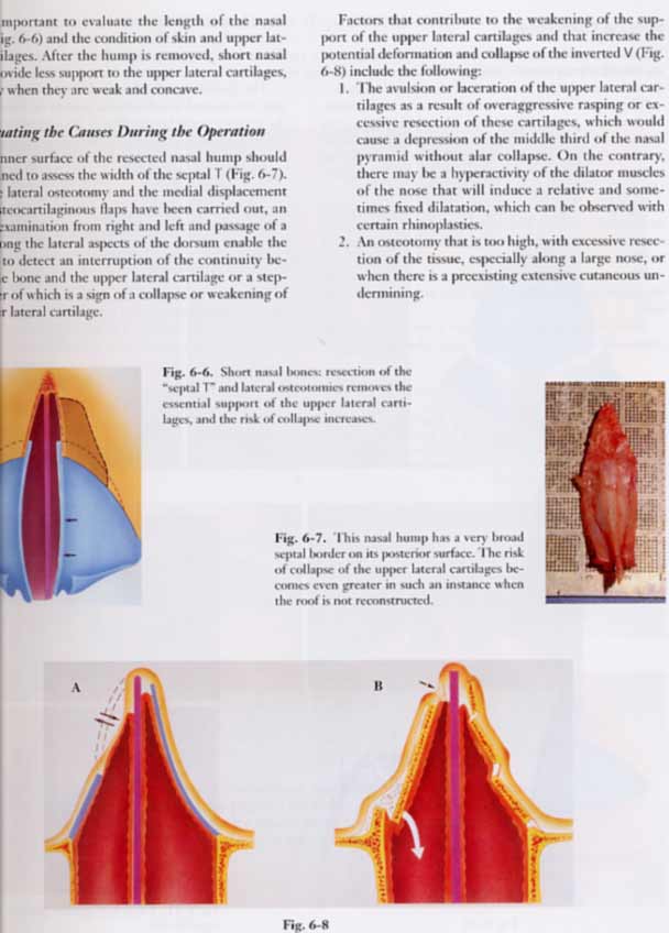 Atlas of Rhinoplasty : Open and Endonasal Approaches