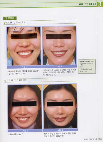 필러의 임상적 사용 : Filler in Facial Rejuvenation