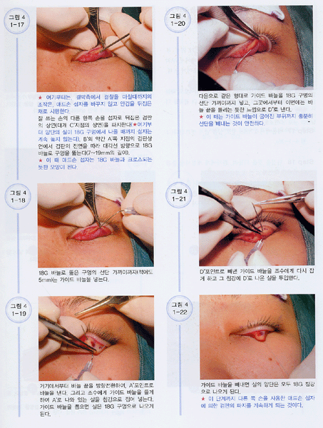 안검 : Atlas of Skill Aesthetic Plastic Surgery