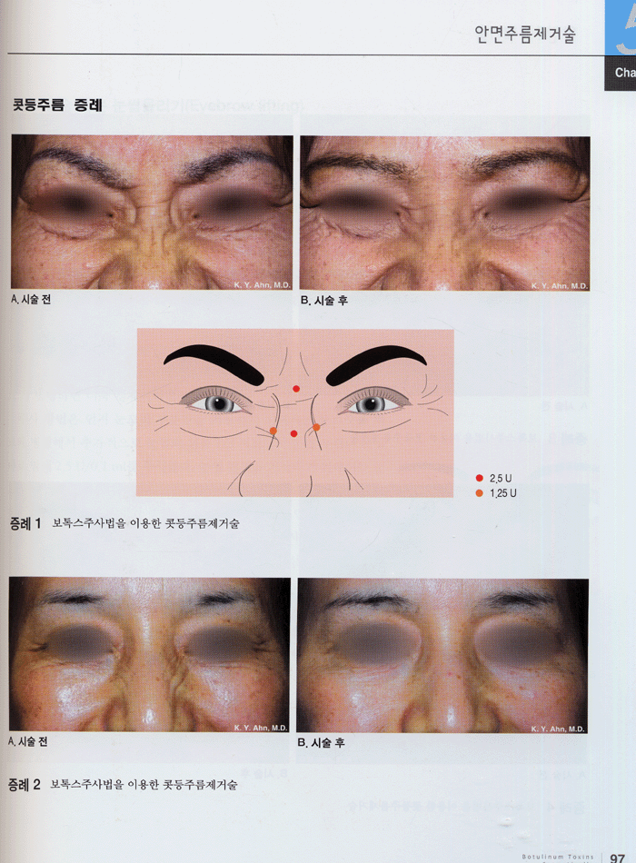 보톡스주사법 : 미용시술편 CD-ROM포함