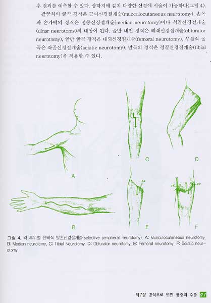 척추성 통증의 최소침습적 치료