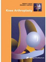 Knee Arthroplasty