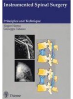 Instrumented Spinal Surgery: Principles and Technique