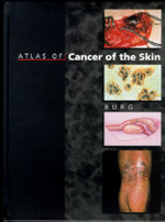 Atlas of Cancer of the Skin