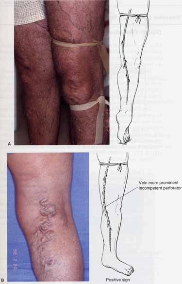 Manual of Sclerotherapy