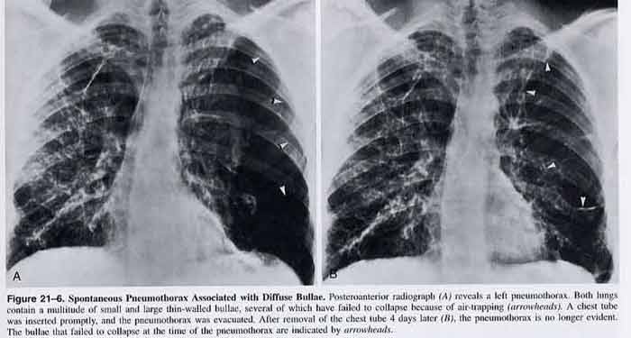 Radiologic Diagnosis of Diseases of the Chest