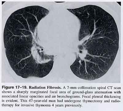 Radiologic Diagnosis of Diseases of the Chest