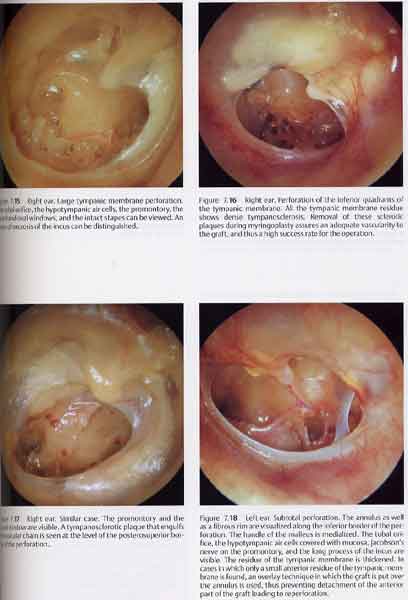 Color Atlas of Otoscopy: From Diagnosis to Surgery