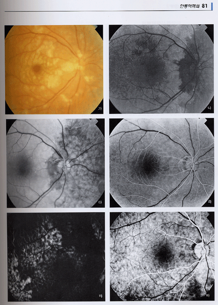 민욱기의 망막질환과 형광안저혈관조영 제3판
