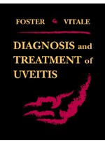 Diagnosis & Treatment of Uvietis