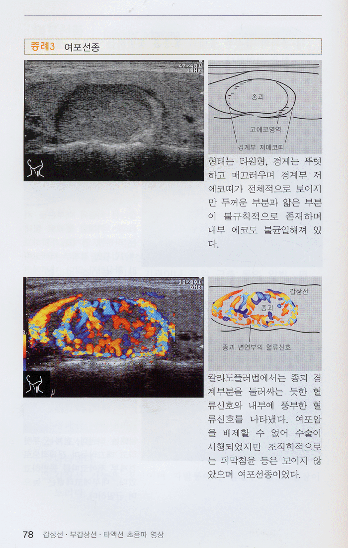 갑상선ㆍ부갑상선 타액선 초음파영상