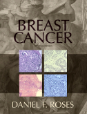 Breast Cancer,2/e