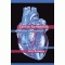 Cardiac Remodeling: Mechanisms and Treatment