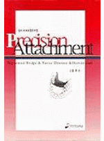 심미 치과보철을 위한 Precision Attachment