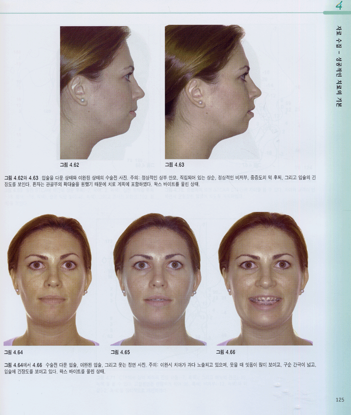 심미를 고려한 악교정수술계획
