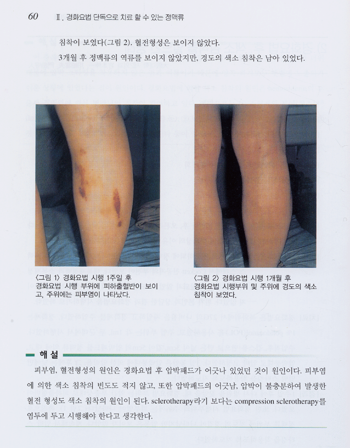 하지정맥류 경화요법의 실제