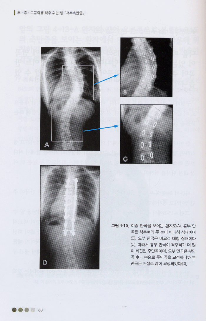 척추측만증 (추나학회)