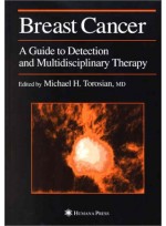 Breast Cancer: A Guide to Detection and Multidisciplinary Therapy