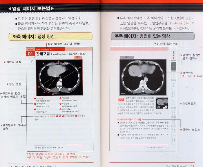 정상영상과 비교하는 복부 골반 CT