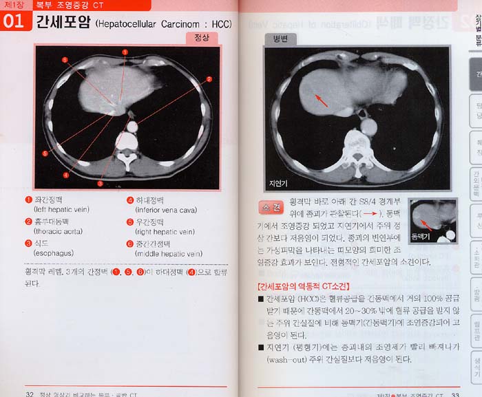 정상영상과 비교하는 복부 골반 CT