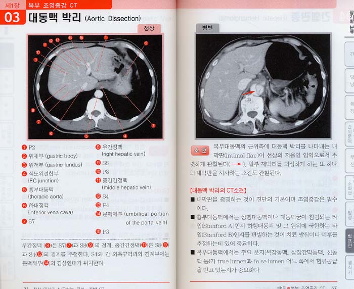 정상영상과 비교하는 복부 골반 CT
