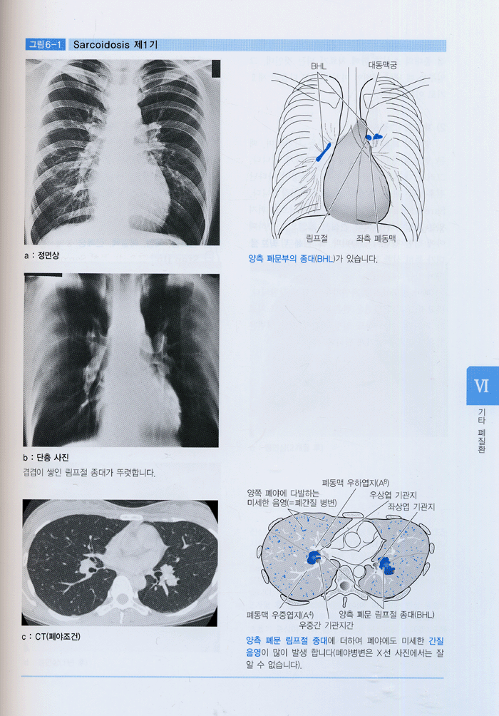 흉부 X선 판독법