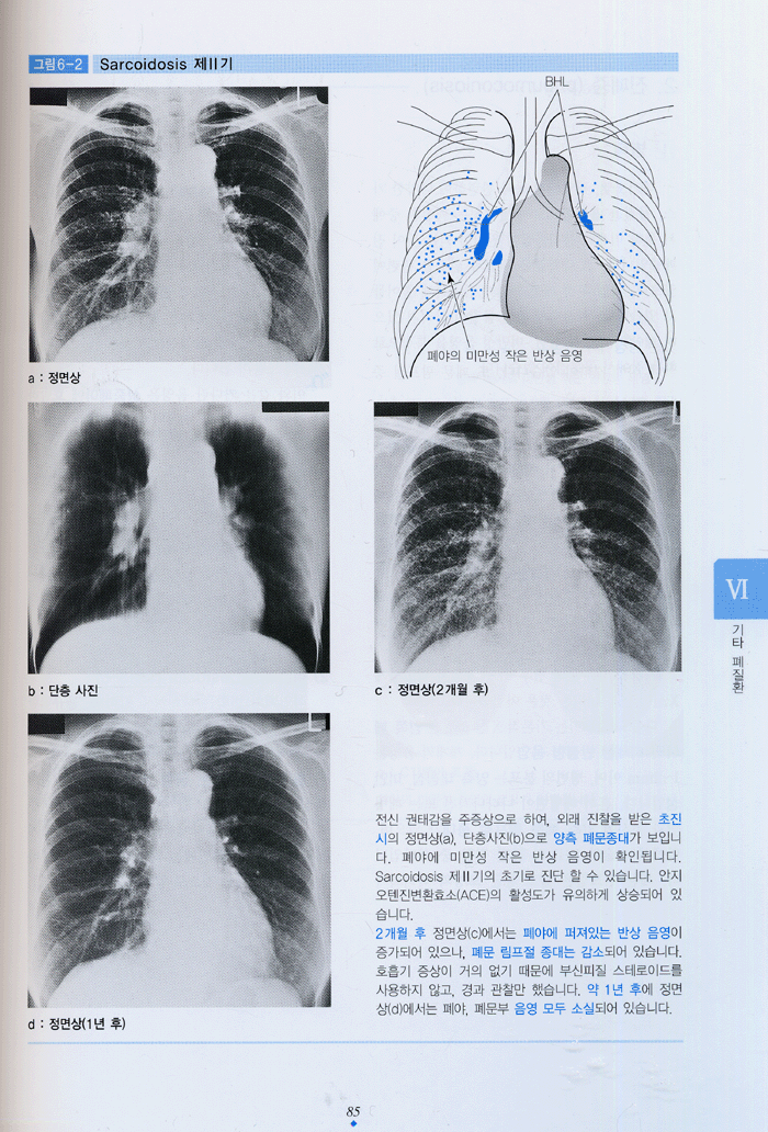 흉부 X선 판독법