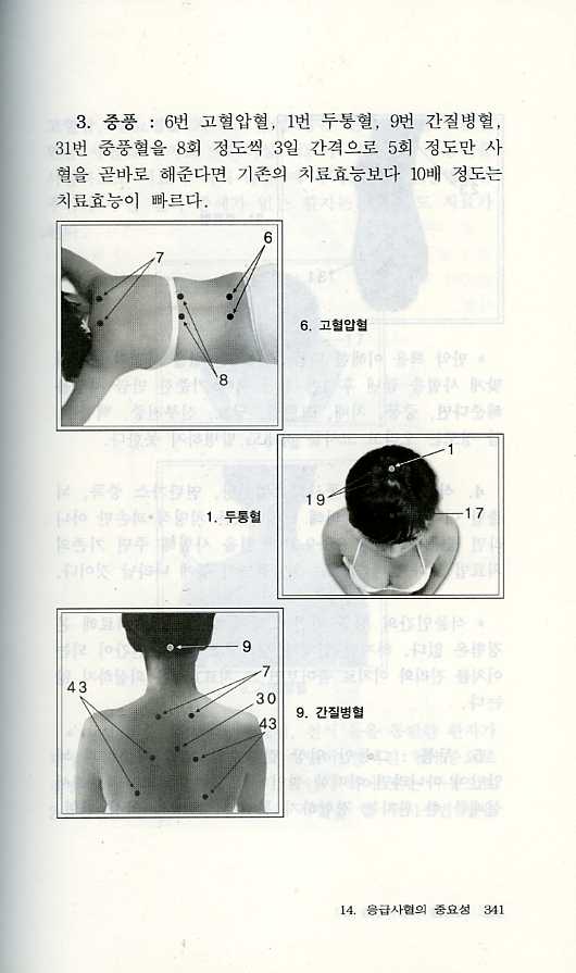 심천사혈요법3